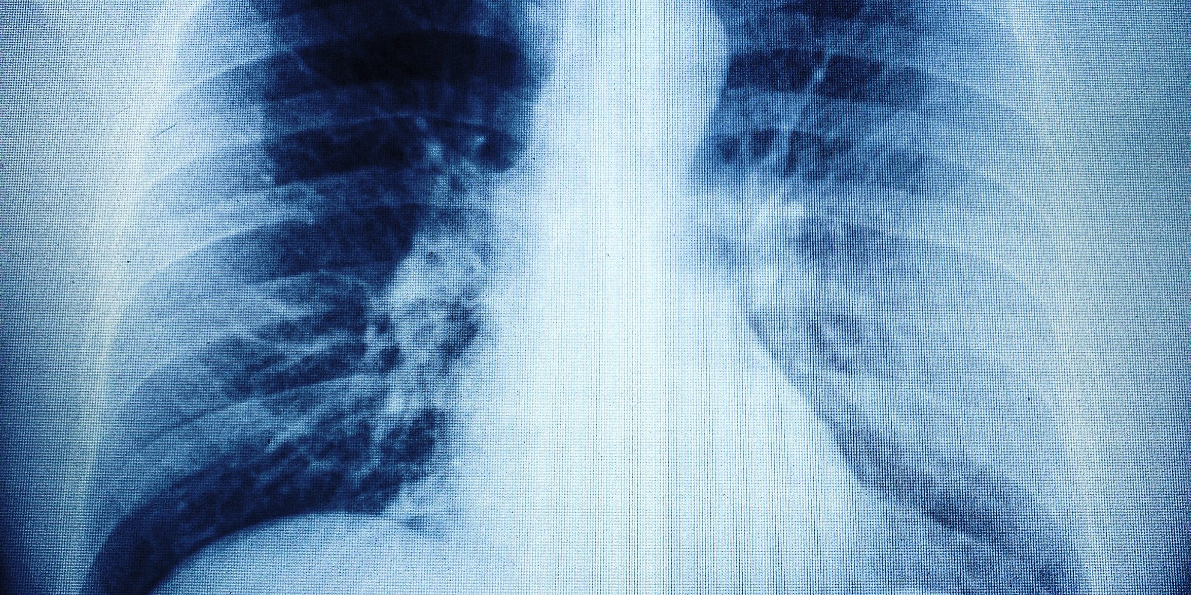 X-Ray of the lungs